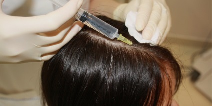 Bras alopecia okait és kopaszság kezelésére hatékony eszközöket (female) Bras alopecia okait és kopaszság kezelésére hatékony eszközöket