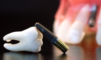 A fogászati ​​implantátum előnye és hátránya - a beteg véleménye