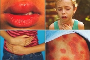 Allergiás kiütések gyermekeknél test különböző betegségek