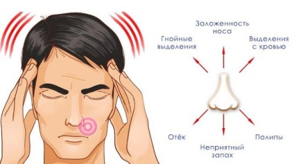 Gombás sinusitis tünetei, kezelése és megelőzése betegségek