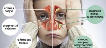 Gombás sinusitis tünetei, kezelése és megelőzése betegségek