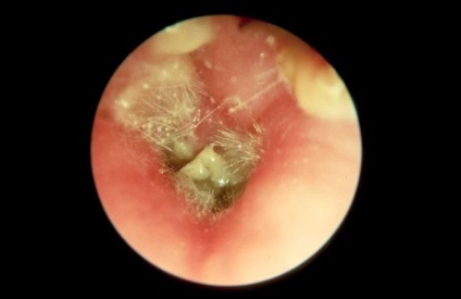 A gomba a fül (otomycosis) - Kép, tünetek, kezelés, megelőzés (tünetek) A gomba a fül (otomycosis) - Kép, tünetek, kezelés, megelőzés