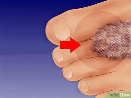 hogyan lehet feltárni a gomba a lábak körmét hiv nail gomba