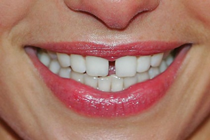 Hogyan lehet eltávolítani a szakadék a foga