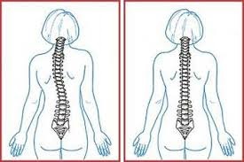 Hogyan válasszuk ki a fűző a hátsó scoliosis 1, 2, 3, 4 fok