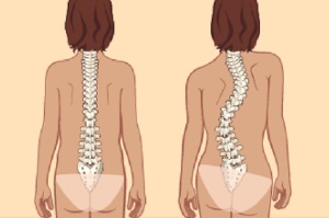 Hogyan válasszuk ki a fűző a hátsó scoliosis 1, 2, 3, 4 fok