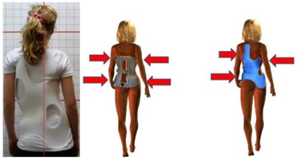 Hogyan válasszuk ki a fűző a hátsó scoliosis 1, 2, 3, 4 fok