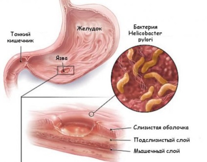 Carcinoma a gyomor tünetek, kezelés, prognózis