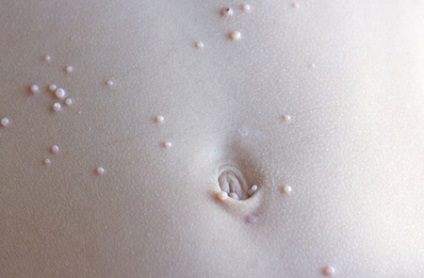 Molluscum contagiosum okok, tesztek, diagnosztizálására, kezelésére és a nitrogén eltávolítása a felnőtteknél