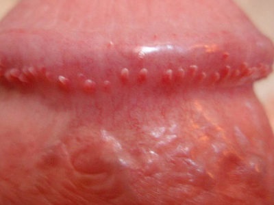 fityma gombás fertőzés férfiaknál képek paraziták vannak a testedben