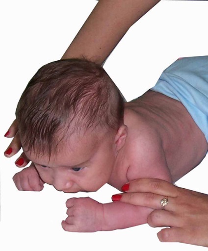 Torticollis újszülöttek - jelek és képek