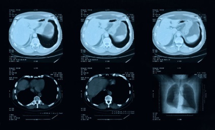 A mellkas CT vizsgálat kontrasztos és előkészítés nélkül, olvasás