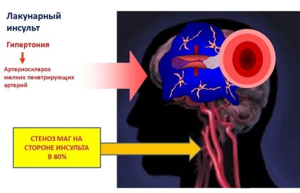 Hézagos ischaemiás stroke és hézagos infarktus az agyi - mi ez