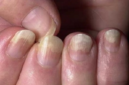 nail fungus kezelés emberek kezelési módszerei