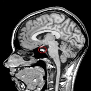 MRI az agyalapi mirigy - különösen a tanulmányokat, jelzések és ellenjavallatok