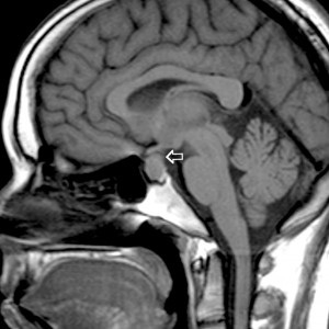 Az agyalapi mirigy adenoma eltávolítása: műtét típusai és jellemzői - Szívroham