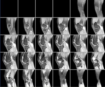 MRI a térd javallatok, ellenjavallatok, előkészítése és a költség