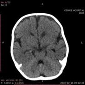 Külső cserélhető agyi hydrocephalus (külső) Kültéri csere agy hydrocephalus