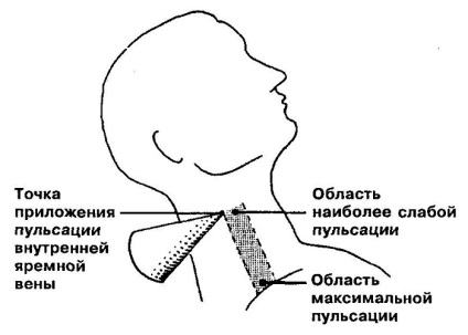 A bővítés a belső nyaki véna a nyak okainak és következményeinek
