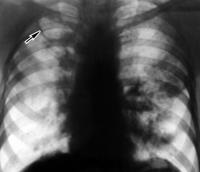 Radiológiai diagnózis tüdőbajban