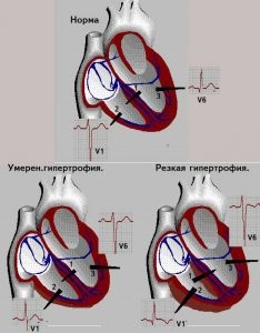 miokardiális infarktus szakaszban jellemzőit mindegyikük