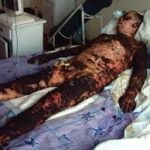 Égések és azok jellemzői (izom-ín) Égések és jellemzőik