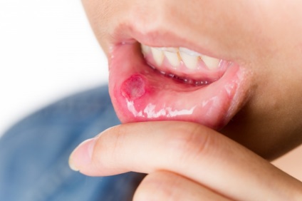 Traumatikus stomatitis kezelésére felnőttek és gyermekek (kezelés) Traumatikus stomatitis kezelésére felnőttek és gyermekek