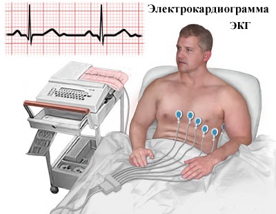 cardiopalmus