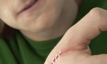 Sebészeti elkötése varratok műtét után az alapvető szabályokat (sebészeti kötszerek) Sebészeti elkötése varratok műtét után alapvető szabályok