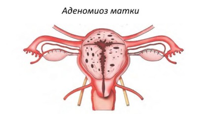 Adenomyosis terhesség és hogy lehetséges-e elképzelni a betegség