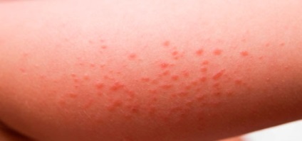 Allergia sóska tünetei, kezelése, a hagyományos és a népi jogorvoslati