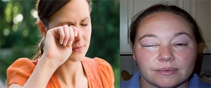 Allergia nyár bolyhok okok, tünetek, kezelés