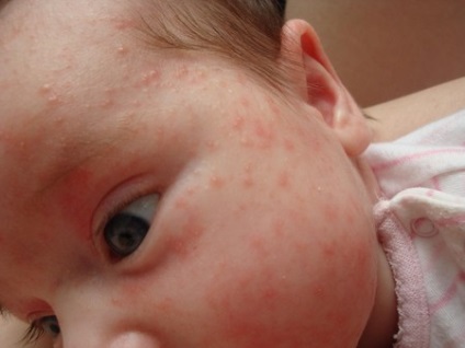 Allergia csecsemőknél arc fotó