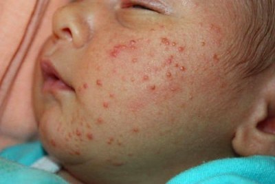 Allergia csecsemőknél arc fotó