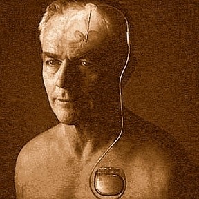 Parkinson-kór - sebészi kezelése (Random) Parkinson-kór - sebészi kezelés