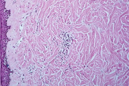 Sklerodermiya- betegség etiopatogenezisében, klinikai kép, a kezelés
