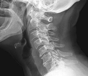 Ami azt mutatja, egy röntgen a nyaki gerinc funkcionális teszteket csinálni ár