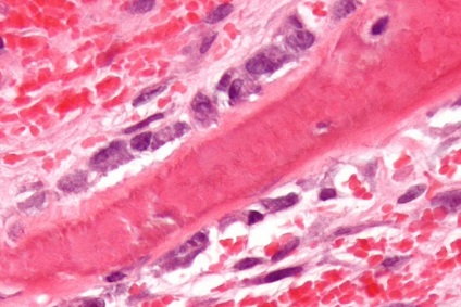 Mi a myeloma multiplex kezelésében, a tünetek és a prognózis (kezelés) Mi a myeloma multiplex kezelésében, a tünetek és előrejelzések