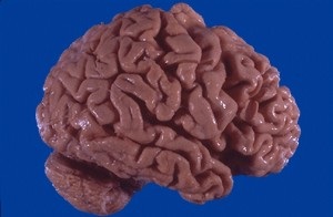 Mi agy porentsefaliya kezelés, prognózis, a klinikai