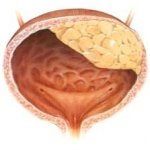 Cystitis, húgyúti megbetegedések