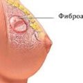 A diszplázia a mell, amely - egy jóindulatú dysplasia dyshormonal