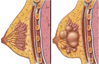 Mell diszplázia, amely - dyshormonal jóindulatú diszplázia (tejsav) A diszplázia a mell, amely - egy jóindulatú dysplasia dyshormonal