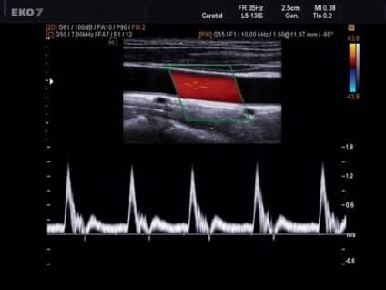 Doppler ultrahang (Milyen eredményeket lehet elérni) Doppler jelentése