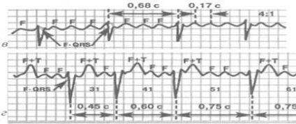 EKG pitvarremegés