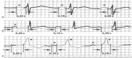 EKG pitvarremegés