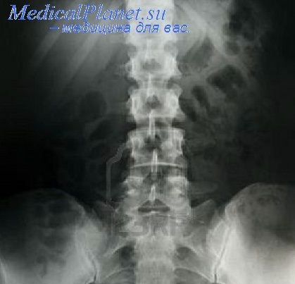 Funkcionális gerinc röntgenvizsgálata