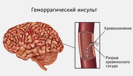 Vérzéses agyvérzés okai és következményei (a következményeket) Vérzéses agyvérzés okai és következményei