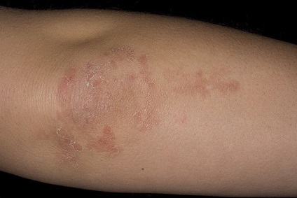 Dermatitis herpetiformis Duhring tetszik megnyilvánult diagnosztizálják és kezelik