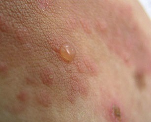Dermatitis herpetiformis Duhring tetszik megnyilvánult diagnosztizálják és kezelik