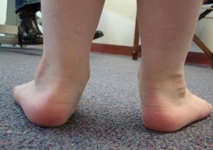 Rugalmas a lábát a gyermek kezelés
